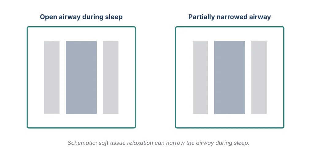 Schematic comparing an open airway during sleep with a partially narrowed airway